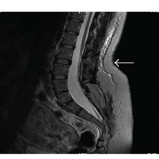 Sagittal view of the patient's MRI scan with spinal cord. The arrow... | Download Scientific Diagram