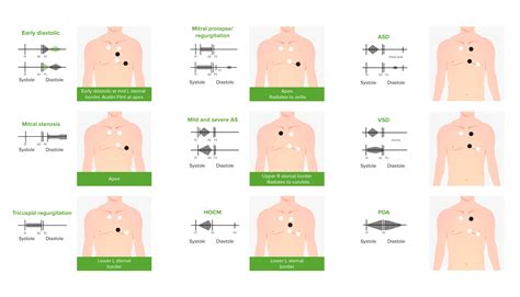 Aortic Regurgitation | Concise Medical Knowledge