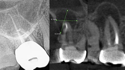 Periapical x-ray cone beam ct scan cbct lesion of endodontic origin ...