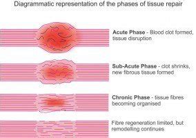 Hot or Cold Therapy for Soft Tissue Injury? Which is Best