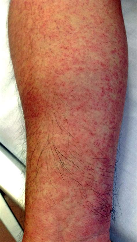 Skin rash from dengue fever | BMJ Case Reports