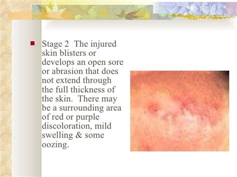 Skin Lesions Prevention