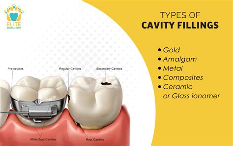 Tooth Cavity Filling