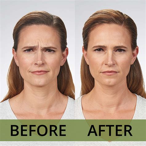 Botox Before And After