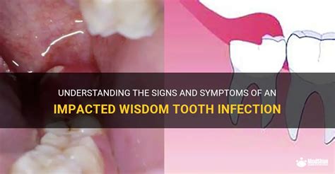 Understanding The Signs And Symptoms Of An Impacted Wisdom Tooth Infection | MedShun