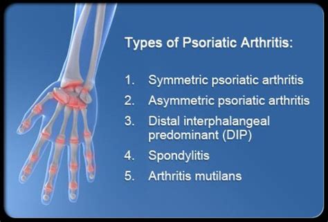 Symptoms, Causes, and Treatment of Psoriatic Arthritis | HealthProAdvice