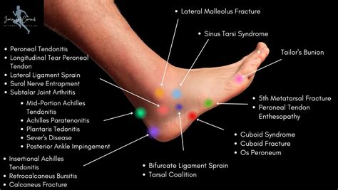 Foot Pain Side Of Foot Diagram at genlunablog Blog