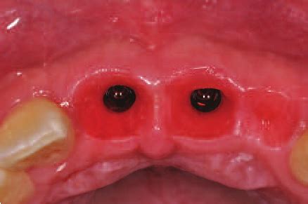 d. Occlusal view of the implant transition zones and ovate pontic... | Download Scientific Diagram