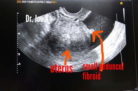 Ultrasound imaging: Small pedunculated fibroid