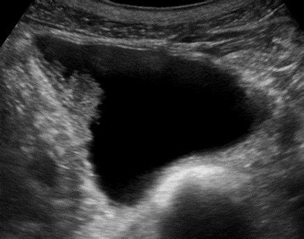 Introduction to Point of Care Urinary Bladder Ultrasound | Point-of-Care Ultrasound ...