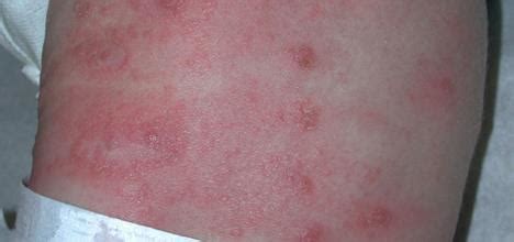 Mild Scabies Rash