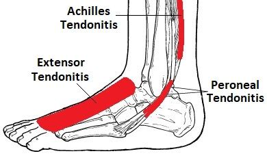 Foot & Ankle Tendonitis: Causes, Symptoms & Treatment (2022)