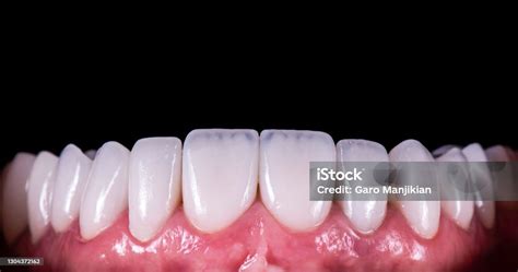 Press Ceramic Veneers B2 Color Stock Photo - Download Image Now - Dental Veneers, Dental Health ...