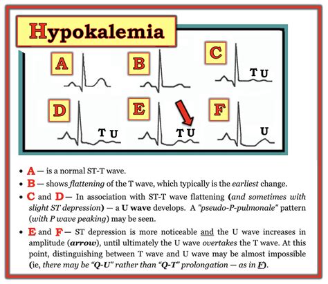 Ecg Ekg Changes In Hypokalemia And Hyperkalemia Ecg Should Be Done On ...