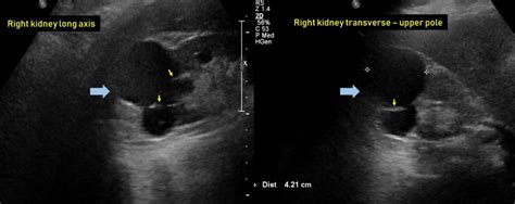 Ultrasound features of Kidney Cysts - Renal Fellow Network