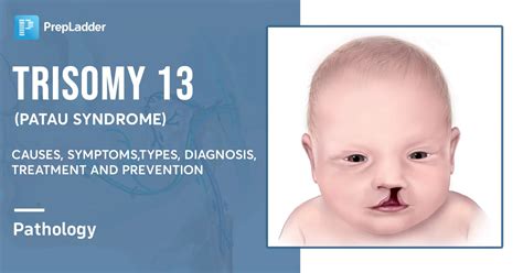 Edwards Syndrome Trisomy 18 Causes Symptoms And Types