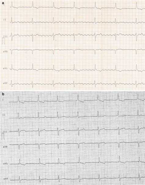 Sinoatrial Exit Block | Thoracic Key