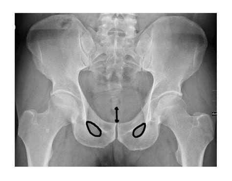 Back to Basics: Pelvic XRays — Taming the SRU