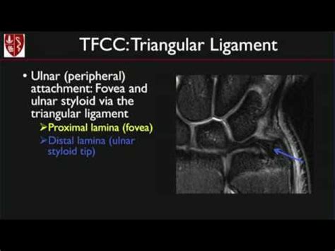 Ulnar Collateral Ligament Wrist Mri