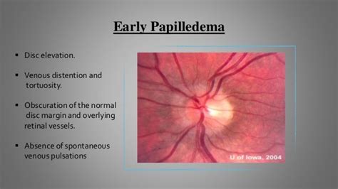 Papilledema Signs