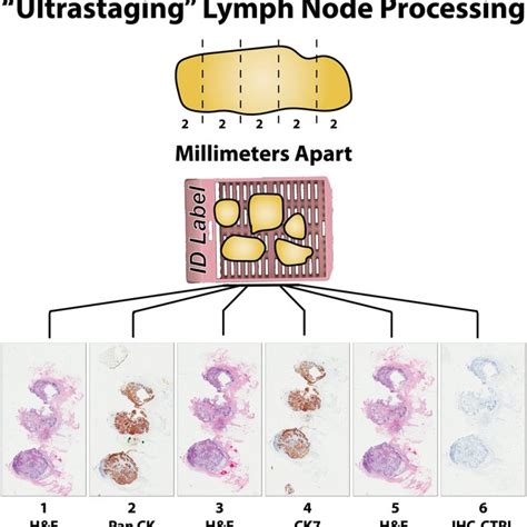 Pathological features associated with sentinel lymph node involvement.... | Download Scientific ...