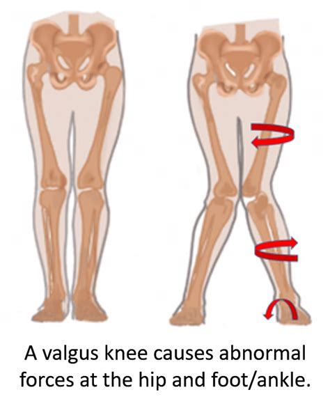 Can You Treat a Valgus Knee Without Surgery?- Regenexx