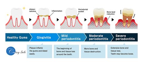 Periodontal Disease Stages