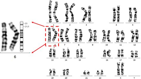 | The proband carries a chromosomal inversion in chromosome ...