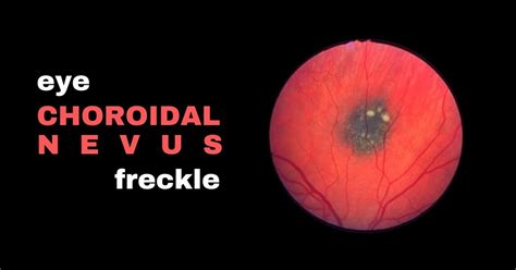 What is a Choroidal Nevus? - Nader Moinfar, MD, MPH, FACS, FASRS