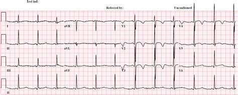 Dr. Smith's ECG Blog: T-wave inversion in a young woman with ...