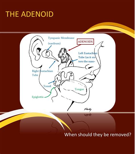 Adenoidectomy: Indications