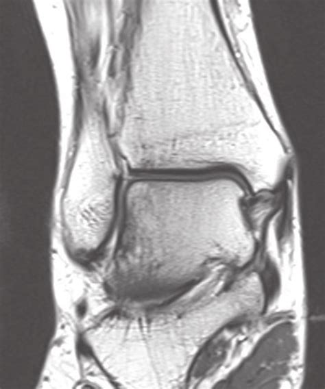 MRI of the deltoid ligament. | Download Scientific Diagram