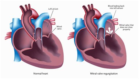 Mitral Valve Regurgitation - Cardiovascular Institute of the Shoals