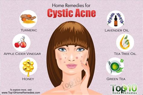 Cystic Acne On Cheeks Treatment - shearlingwomenbestquality