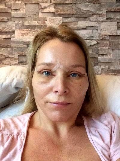 SMAS Facelift Recovery Pictures (7) » Facelift: Info, Prices, Photos, Reviews, Q&A