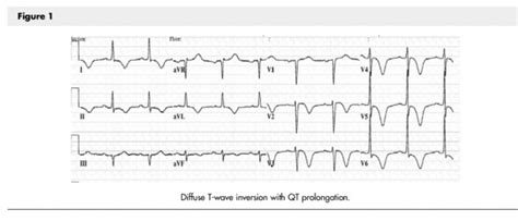 Hypocalcemia - Physiopedia