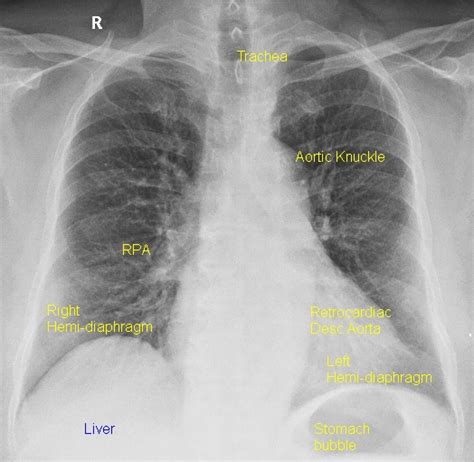 X-ray Chest PA view (CXR-PA) | Cardiophile MD