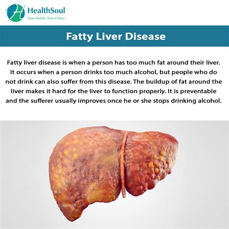 Enlarged Liver Symptoms Causes Diagnosis And Treatment Natural