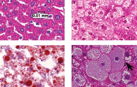 Hepatic Lipidosis Histology