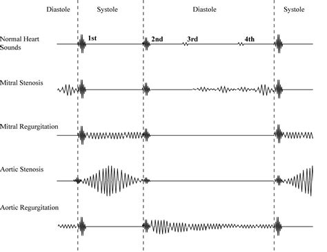 Heart Murmur Diagram Heart Murmurs — Take Aurally