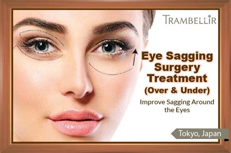 Eye Sagging Surgery Treatment (Improve Sagging Around the Eyes) [Shinjuku] | Trambellir