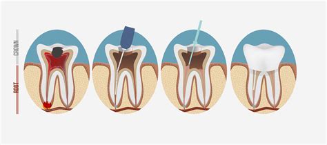 Root Canal Therapy in Christies Beach | Beach Road Dental