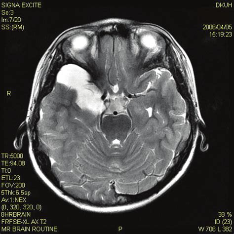 Brain Cyst Mri