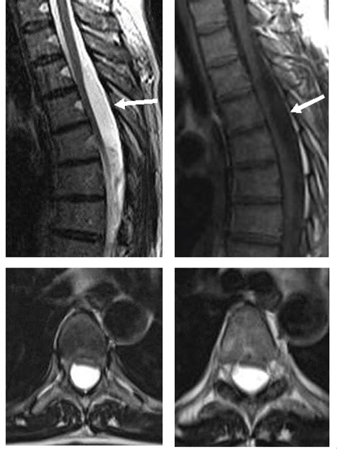 Spinal Arachnoid Cyst