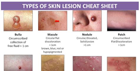 Identifying Skin Lesions