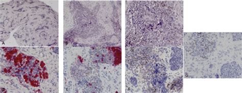 Pathology and immunohistochemical analysis. A, B, C: Association of... | Download Scientific Diagram