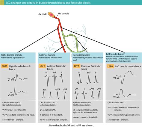 Intraventricular conduction delay: bundle branch blocks & fascicular blocks – ECG learning