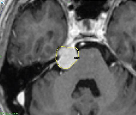 Trigeminal neuralgia due to petroclival meningioma – upfront radiosurgery | Radiology Key