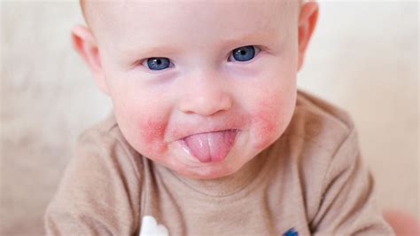 Teething Rash: What Is It And How To Treat It Johns, 60% OFF