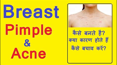 pimples on breast || Breast pimple or acne causes, treatment and prevention in hindi - YouTube